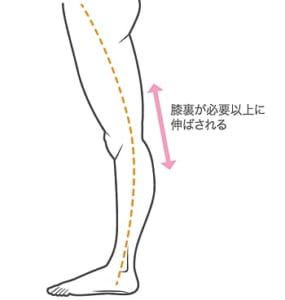 反張膝だと膝裏が必要以上に伸ばされるという説明