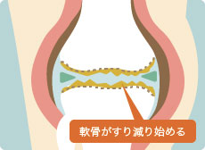 変形性膝関節の初期の膝関節