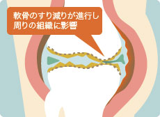 変形性膝関節症の進行期の膝関節
