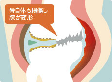 変形性膝関節症の末期の膝関節