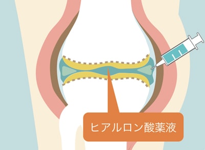 ヒアルロン酸注射とステロイド注射の違い