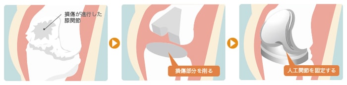 人工膝関節置換術の手術方法