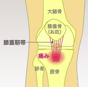 膝蓋靭帯炎とは