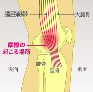 腸脛靭帯炎とは