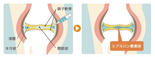 膝のヒアルロン酸注射