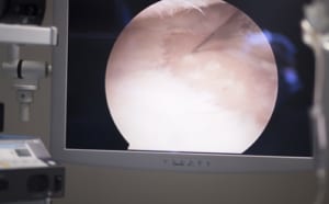 半月板の手術の仕方