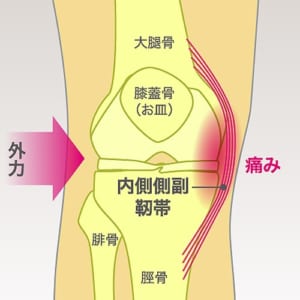 内側側副靭帯損傷とは