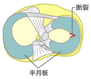 半月板損傷とは