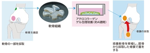 膝痛治療の自家培養軟骨移植術