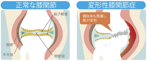 変形性膝関節症とは