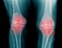 変形性膝関節症の代表的な症状と対処法【セルフチェックあり】