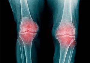 変形性膝関節症の代表的な症状と対処法【セルフチェックあり】