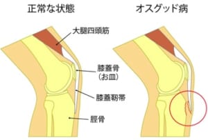 オスグッド病とは