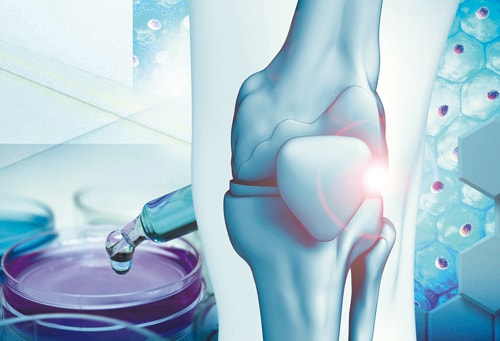 膝痛に新治療が続々登場！知っておくべき再生医療の注目ポイント