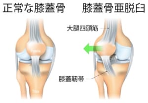 膝蓋骨亜脱臼とは
