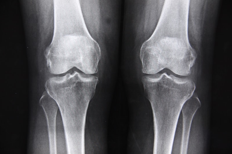 膝の激痛「偽痛風」とは？症状や段階別の治療法を解説