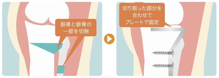 変形性膝関節症の骨切り手術:クローズドウェッジ法(O脚の場合:アプローチ部位は左足の外側)