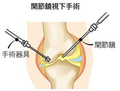 関節鏡視下手術