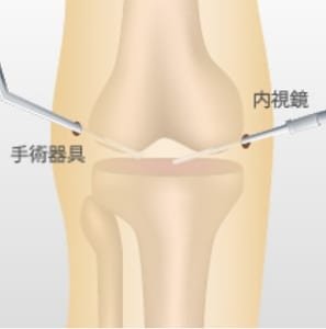 膝の捻挫の手術療法