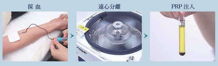 PRP療法の治療の流れ