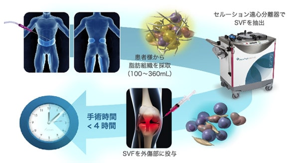 脂肪幹細胞による変形性膝関節症治療の流れ