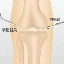 関節鏡視下手術