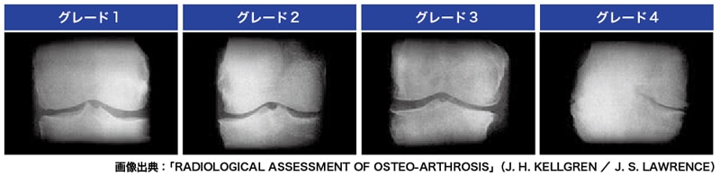 変形性膝関節症のグレード