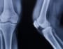 膝のお皿が割れる「膝蓋骨骨折」の手術やリハビリを知る必読書