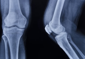 膝のお皿が割れる「膝蓋骨骨折」の手術やリハビリを知る必読書