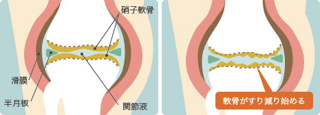 変形性膝関節症