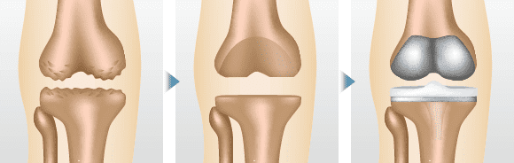 人工膝関節全置換術