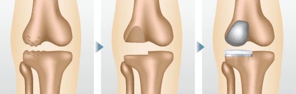 人工膝関節単顆置換術