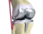 【人工膝関節置換術でよくある疑問】手術方法や費用もまとめて解説