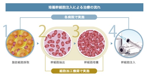 培養幹細胞治療