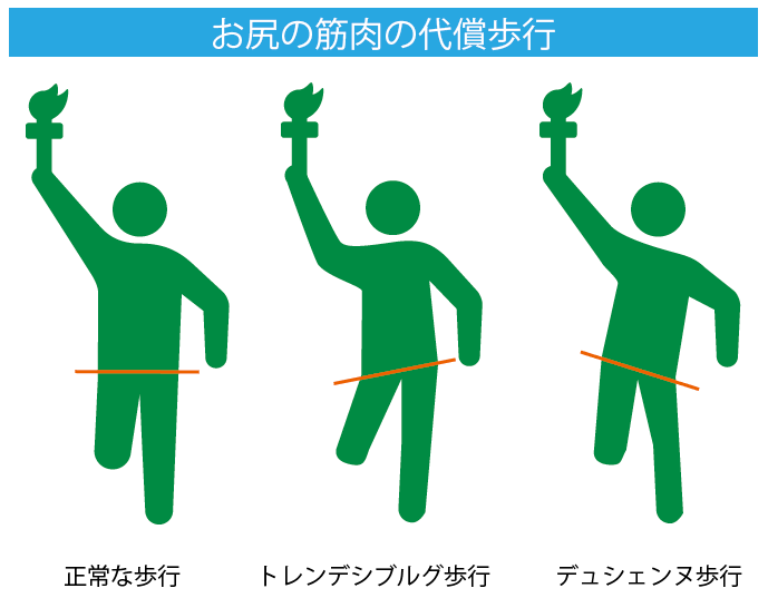トレンデレンブルグ歩行とデュシェンヌ歩行