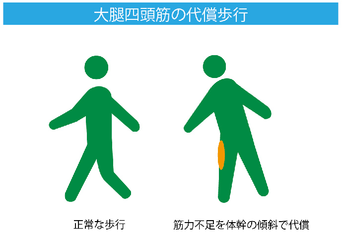 大腿四頭筋の代償歩行