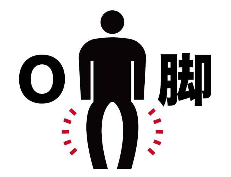 変形性膝関節症とO脚の負の連鎖を断ち切る専門家の矯正法とは?